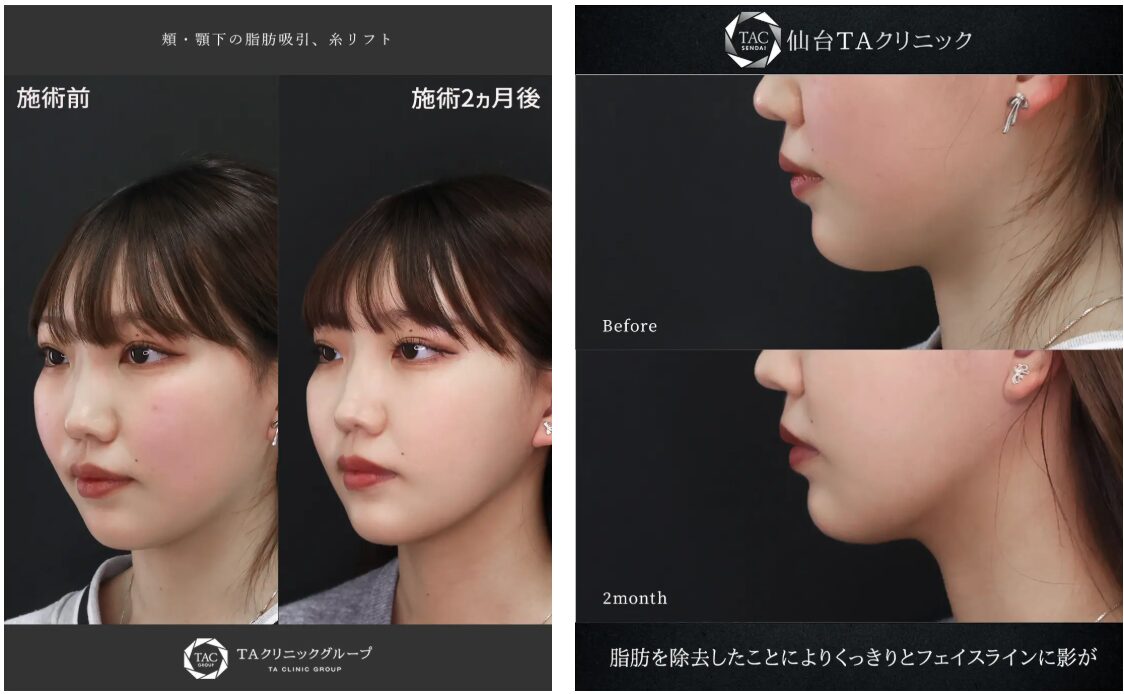 TAクリニックの小顔に関する施術の症例写真です。
