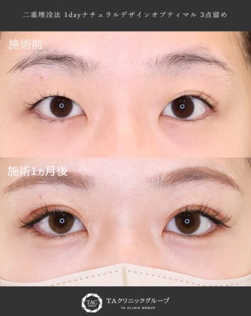 TAクリニック二重埋没法の症例写真