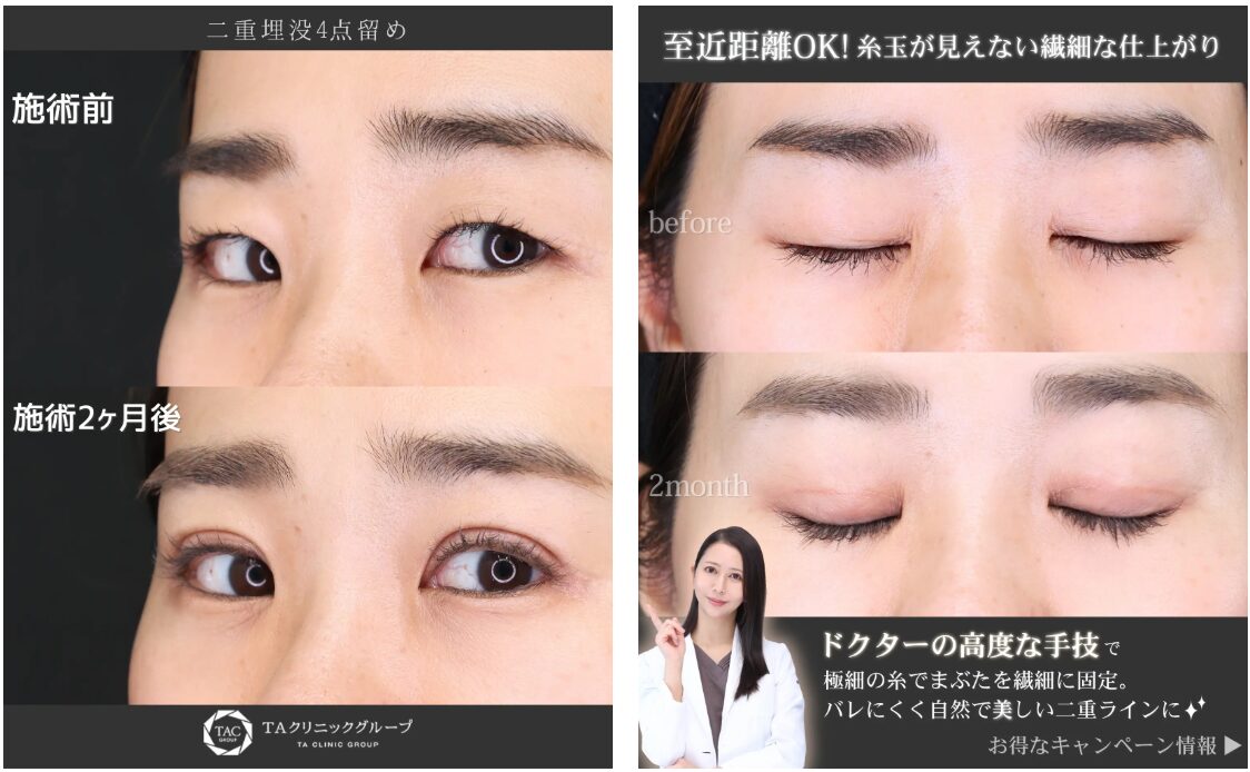 TAクリニックの二重埋没法（4点留め）の症例写真です。