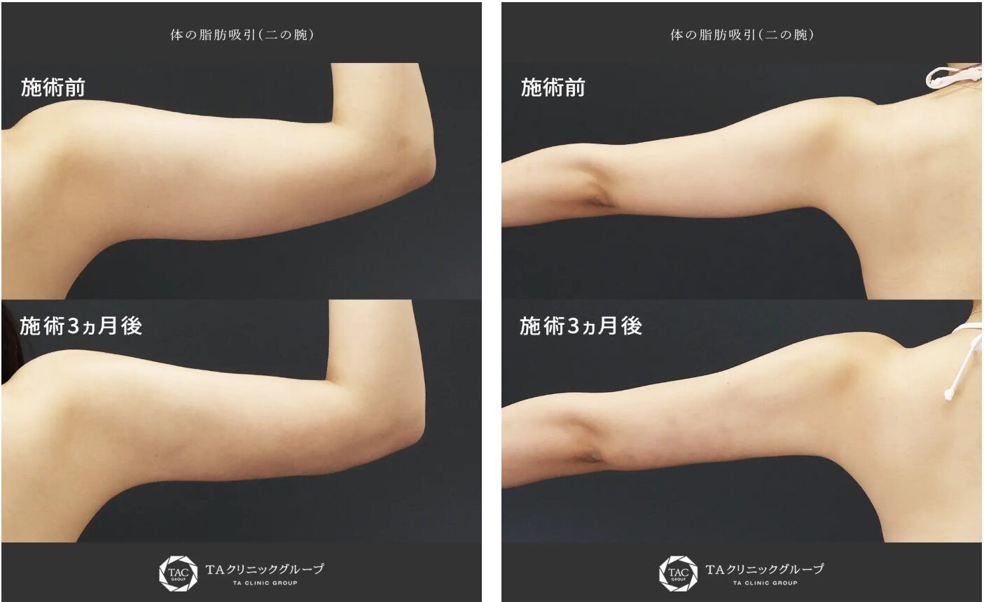 症例写真：二の腕の脂肪吸引