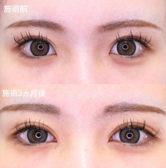TAクリニック目頭切開の症例写真