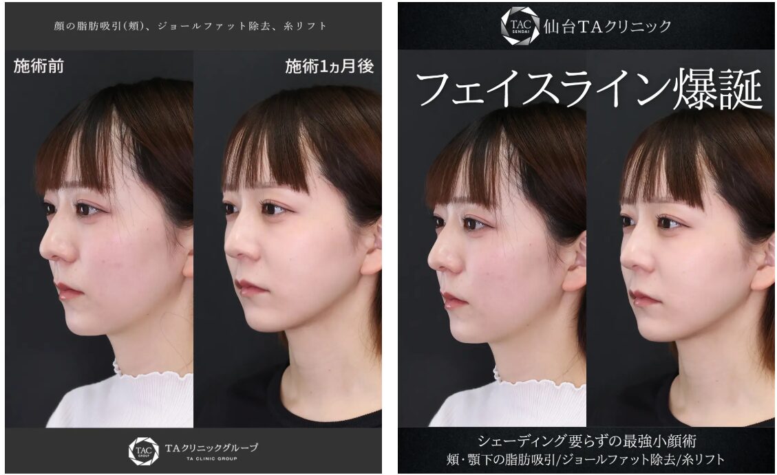 TAクリニックの小顔に関する施術の症例写真です。