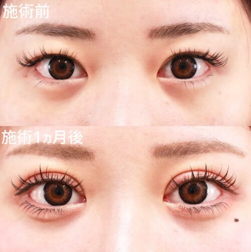 TAクリニック二重切開（全切開法）の症例写真