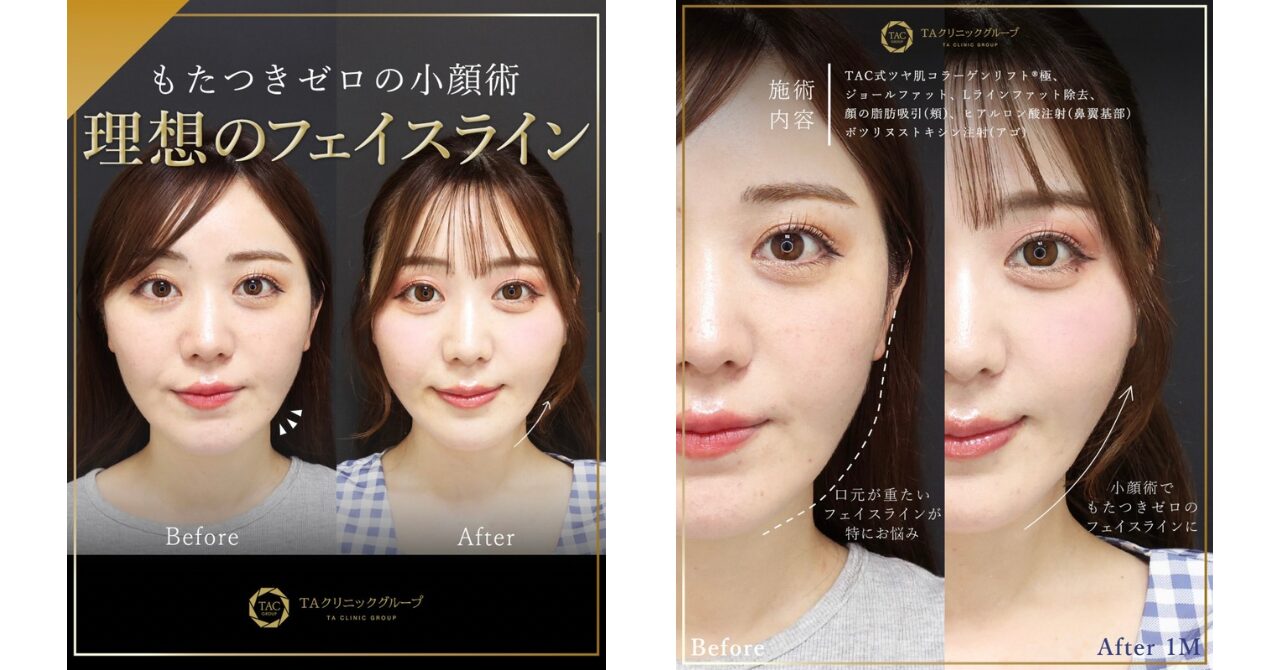 TAクリニックの小顔術に関する症例画像です。