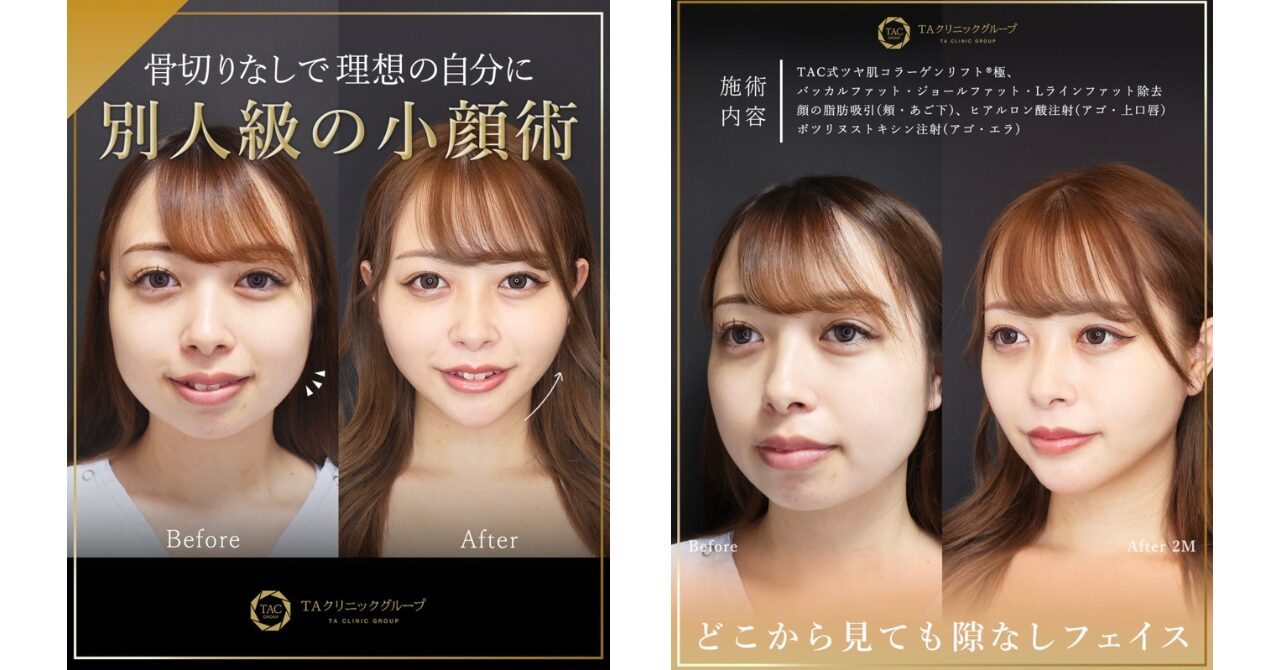 TAクリニックの小顔整形