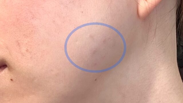 品川美容外科の福岡院で、エラボトックスを2倍量の100単位！ダウンタイム、痛みがほぼなし