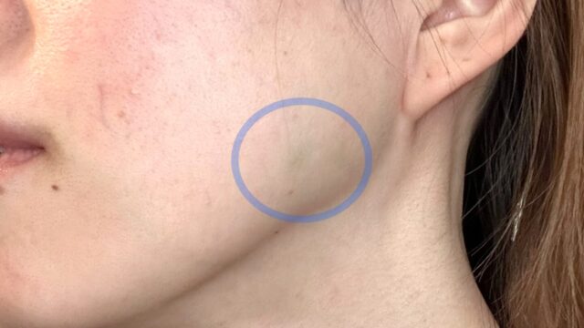 エラボトックスを品川美容外科の福岡院で体験！痛くなかった