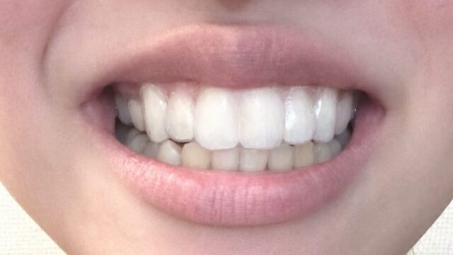 マウスピースは目立たないので、ほとんど気になりません。