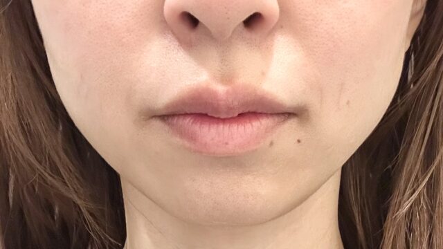 品川美容外科の福岡院で、エラボトックスを2倍量の100単位やったら、効果を実感できた