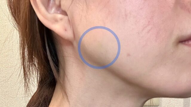 エラボトックスを100単位したら、ダウンタイムがほぼなかった。