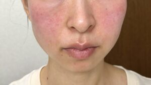 酒さ、敏感肌、脂性肌の私が過去一番肌荒れしたときの様子