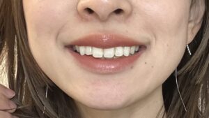 歯が白くなると、肌のトーンが上がるような気がしてモチベが上がります。私は断然、マウスピース＆ジェル薬剤のホームホワイトニング派です。
