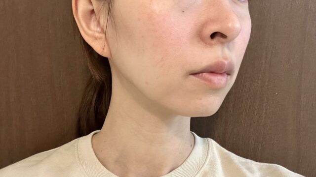品川美容外科なら、クーポンで初回が安いのでエラボトックスを受けるならおすすめ