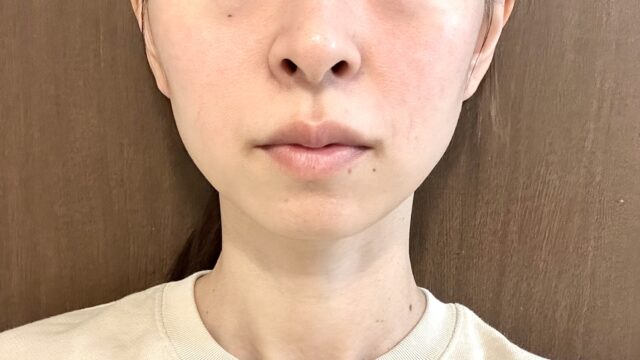 エラボトックス100単位で小顔効果を実感