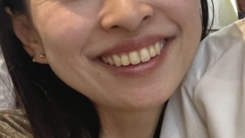 自宅でできるホワイトニングには、マウスピースとジェルの薬剤が必要。安く済ませるなら、上だけでも！