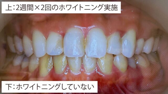 ホワイトニングのビフォーアフター写真。2週間×2回の実施でかなり効果を実感。歯の白さを感じます。